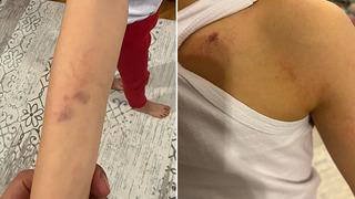 Anaokulunda rezalet! Çocuğunda morluklar gören baba şoke oldu