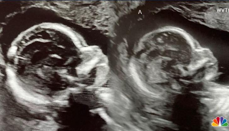 Milyonda bir ihtimaldi... Çift rahimle doğan kadın hamile! İki rahminden de doğum yapacak G2