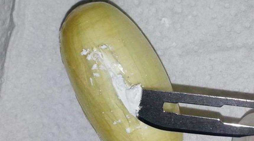 Brezilyalı kadının midesinde 59 kaps&uuml;l kokain