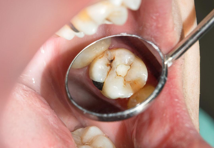 Diş ağrısıyla dişçiye gitti, prostat kanseri olduğunu öğrendi! Ağızda görülen bu semptomlara dikkat G5