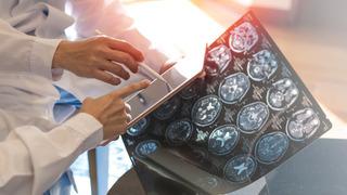 MS hastalığı nedir, neden olur? MS belirtileri nelerdir?