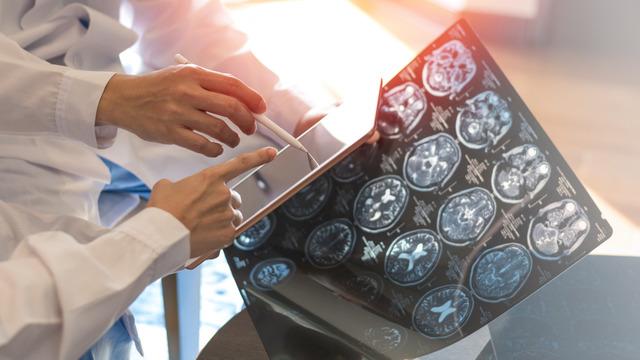 MS hastalığı nedir, neden olur? MS belirtileri nelerdir?