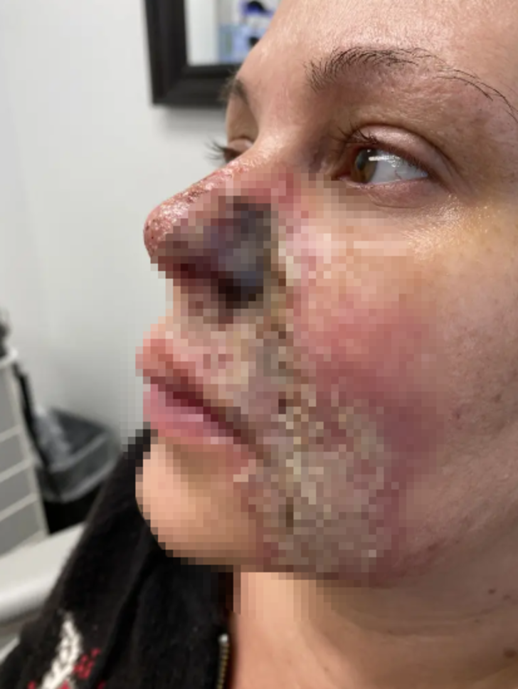 Güzelleşmek için bıçak altına yattı! Yüz dolgusu burnunu yaktı... "Burnumdan et parçasının koptuğunu hissettim" G2