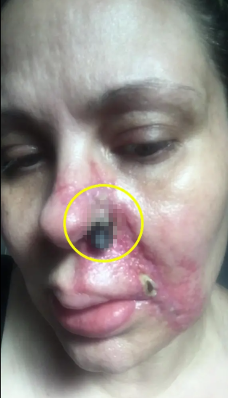 Güzelleşmek için bıçak altına yattı! Yüz dolgusu burnunu yaktı... "Burnumdan et parçasının koptuğunu hissettim" G3