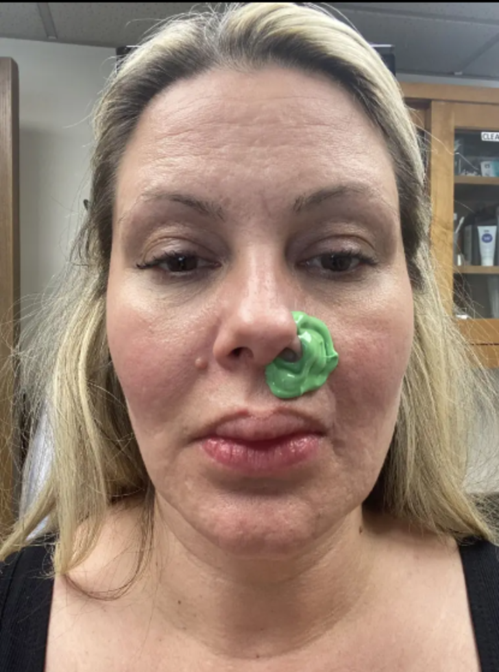 Güzelleşmek için bıçak altına yattı! Yüz dolgusu burnunu yaktı... "Burnumdan et parçasının koptuğunu hissettim" G4