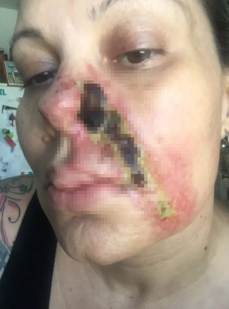 Güzelleşmek için bıçak altına yattı! Yüz dolgusu burnunu yaktı... "Burnumdan et parçasının koptuğunu hissettim" G5