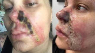 Güzelleşmek için bıçak altına yattı! Yüz dolgusu burnunu yaktı... Burnumdan et parçasının koptuğunu hissettim