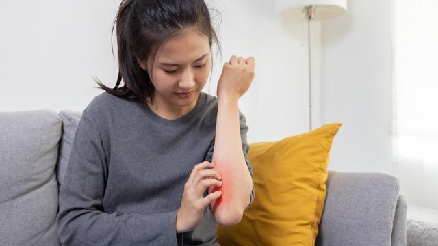 Pirenin ısırdığı yer neden çok kaşınır? Pire ısırıklarına ne iyi gelir?