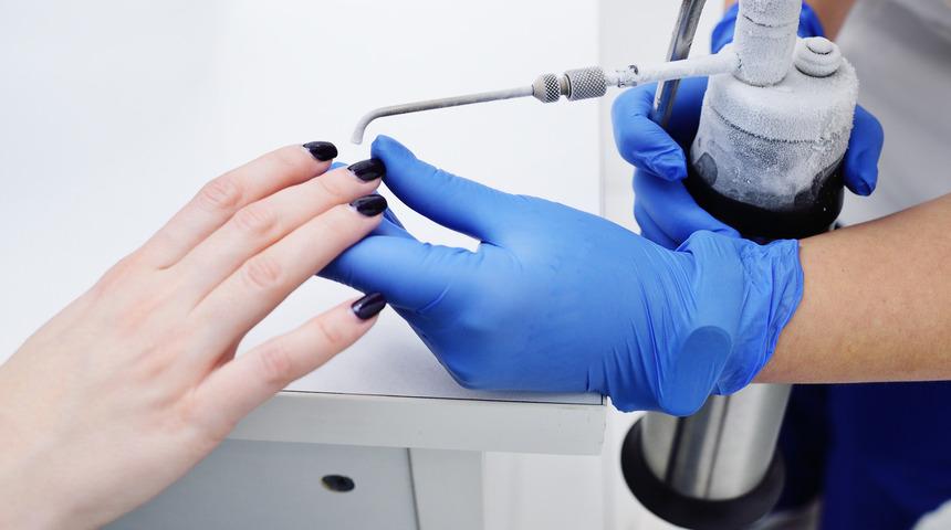 Siğil nedir, neden olur? Siğil nasıl geçer, ne iyi gelir?