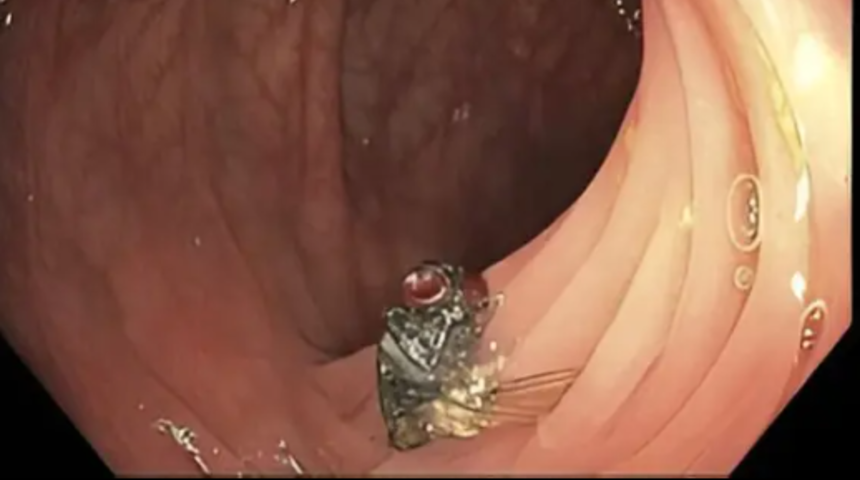 Kolonunda keşfedilen canlı sinek doktorları şok etti! "Bu daha &ouml;nce duyulmamış bir şey"