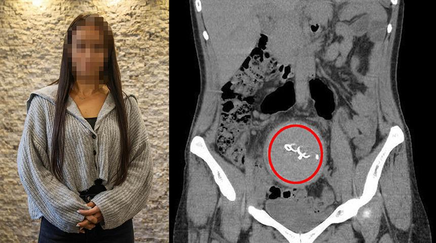 &Ouml;zel hastanede skandal! Doğum sırasında oldu, 2 yıl sonra fark edildi