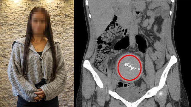 Özel hastanede skandal! Doğum sırasında oldu, 2 yıl sonra fark edildi