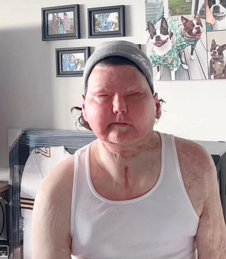 Dünyada gerçekleştirilen ilk organ nakilleri! Domuz kalbi, biyonik penisi yüz nakli...  G2