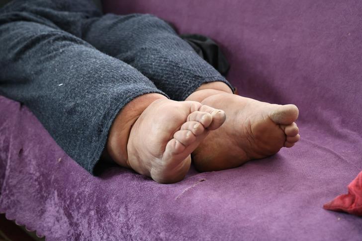 Milyonda bir görülüyor: Bu hastalığın tedavisi yok... Ayakları her yıl 7 santim büyüyor! G4