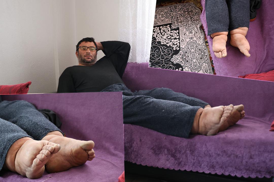 Milyonda bir g&ouml;r&uuml;l&uuml;yor: Bu hastalığın tedavisi yok... Ayakları her yıl 7 santim b&uuml;y&uuml;yor!