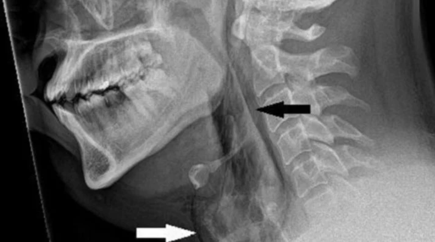 Küresel çapta ilk vaka! Taylandlı adamın hapşırığını tutmak isterken nefes borusu yırtıldı... Tıp dünyasını şaşkına çevirdi