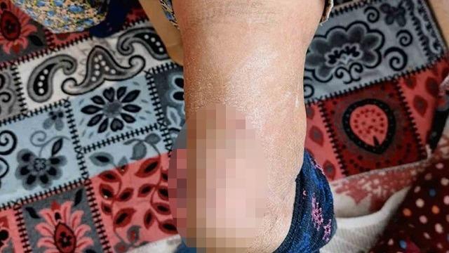 Ayak ağrısı şikayetiyle gitti, topuğundan çıkan tel şoke etti! Tam 37 santim