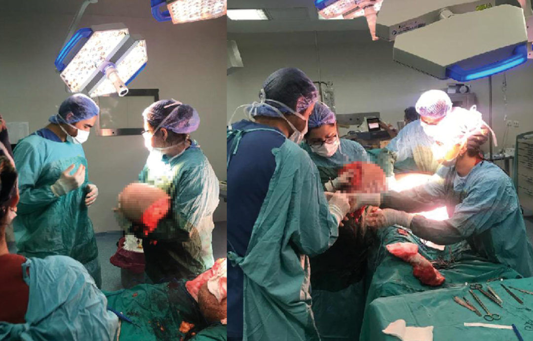 V&uuml;cudundan 25 kilo yağ dokusu &ccedil;ıkarttılar! 6 adım dahi atamıyordu... "T&uuml;rkiye'de ve d&uuml;nyada da olduk&ccedil;a nadir yapılan ameliyatlardan"