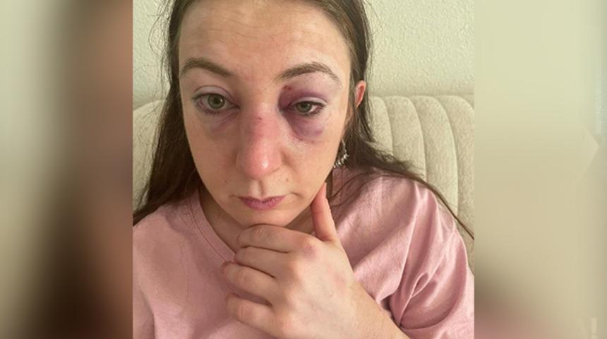 Eski sevgilisinin yüzüne 9 defa kafa atıp "Hadi şimdi git, şikayet et" demişti! Attığı her kafa için 1 yıl hapis cezası istendi 