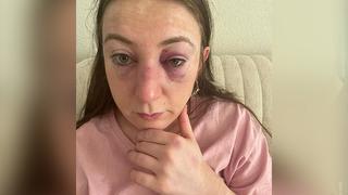 Eski sevgilisinin yüzüne 9 defa kafa atıp Hadi şimdi git, şikayet et demişti! Attığı her kafa için 1 yıl hapis cezası istendi 