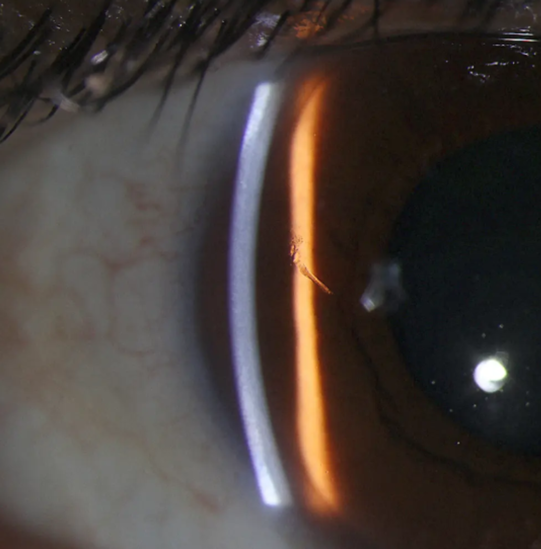 Tam 15 yıldır oradaydı! Doktorlar adamın g&ouml;z&uuml;ne batan kıymığı 15 yıl sonra buldu... "Bu olağan&uuml;st&uuml;"