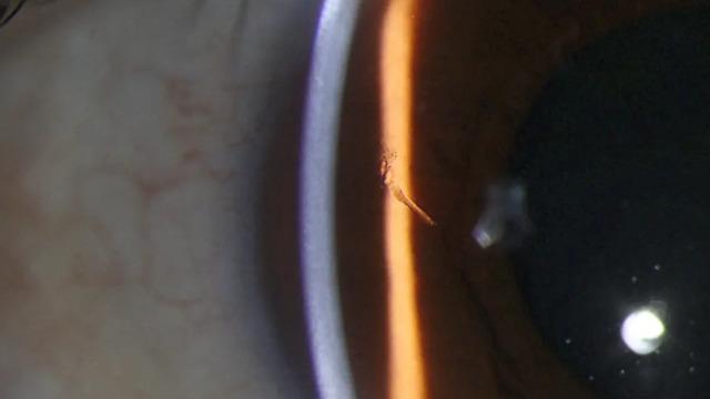 Tam 15 yıldır oradaydı! Doktorlar adamın gözüne batan kıymığı 15 yıl sonra buldu... Bu olağanüstü