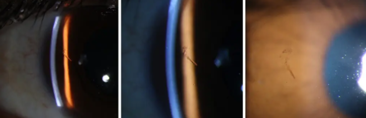 Tam 15 yıldır oradaydı! Doktorlar adamın gözüne batan kıymığı 15 yıl sonra buldu... "Bu olağanüstü" G2