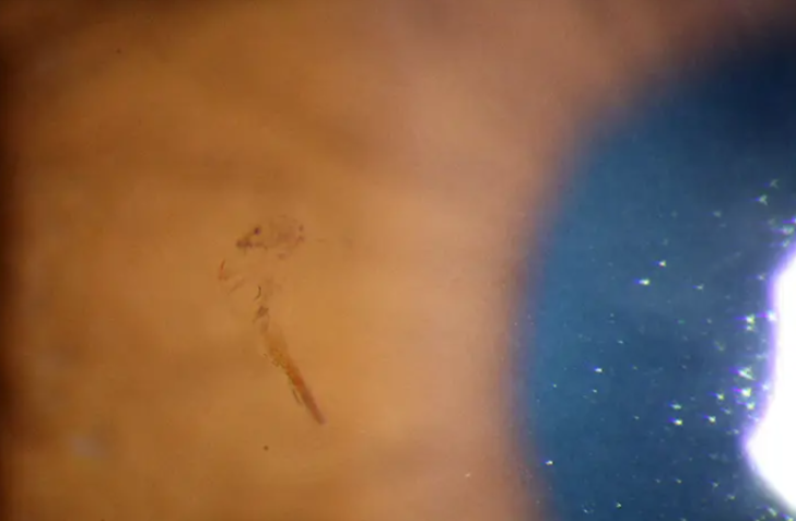 Tam 15 yıldır oradaydı! Doktorlar adamın gözüne batan kıymığı 15 yıl sonra buldu... "Bu olağanüstü" G3