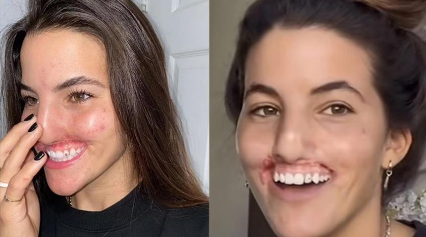 Korkunç pitbull saldırısı! Dudakları ve burnunun bir kısmını kaybetti: İskelete benziyordum