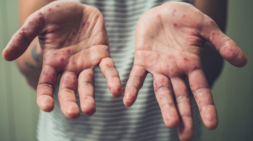 Deride pul pul dökülme ile kendini gösteriyor! Uzman isimler büyük tehlikeye karşı uyardı