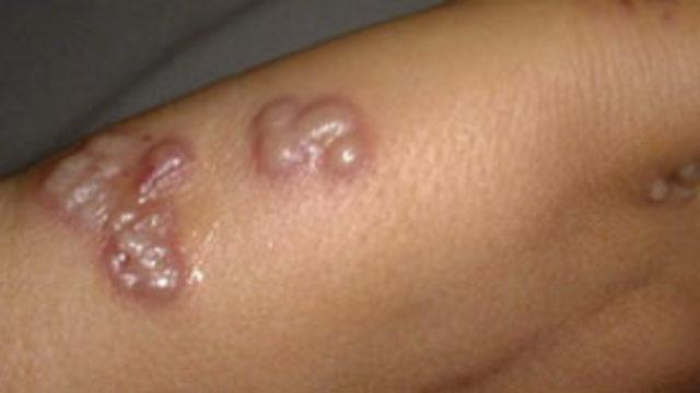 Zona nedir? Niçin tekrarlar?