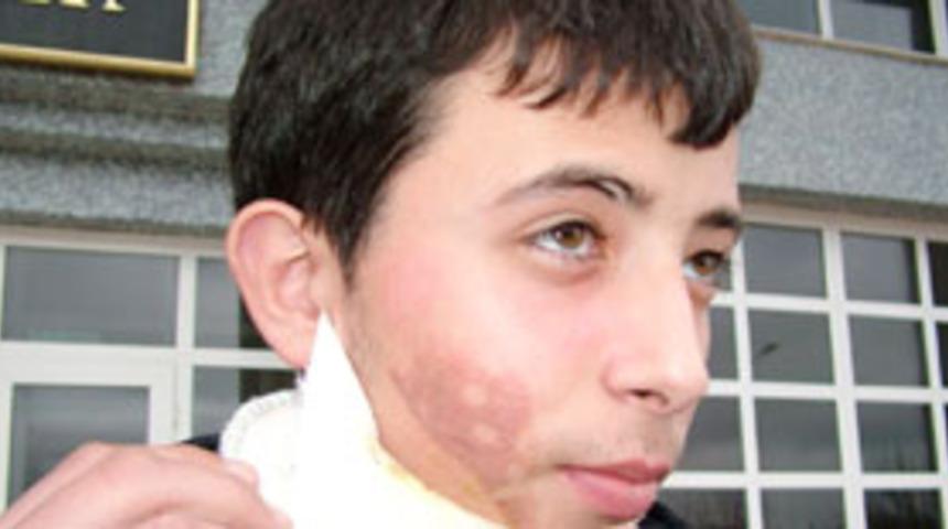 &Ouml;ğretmen &ouml;ğrencinin y&uuml;z&uuml;n&uuml; yaktı