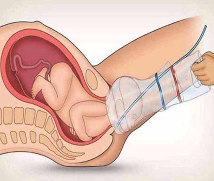 Bu Cihaz Doğumu Kolaylaştırcak