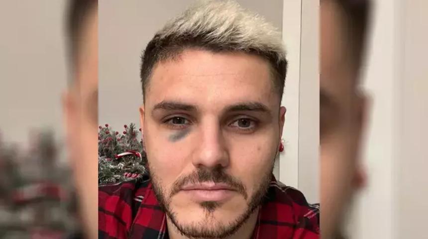 Fenerbahçe maçında darbe almıştı! Galatasaray'dan Mauro Icardi'nin sağlık durumuyla ilgili açıklama