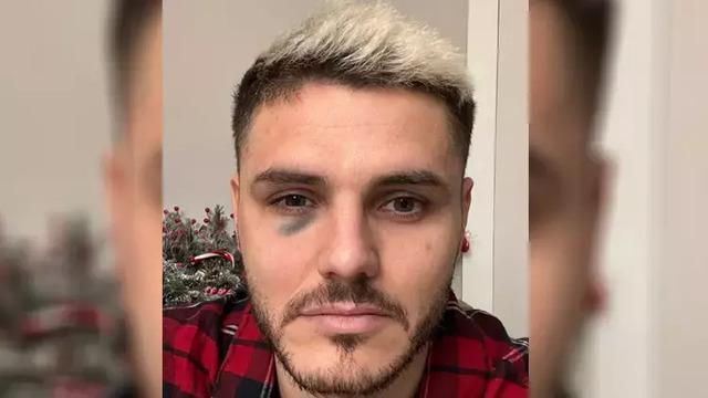 Fenerbahçe maçında darbe almıştı! Galatasaray'dan Mauro Icardi'nin sağlık durumuyla ilgili açıklama