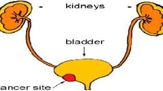 Mesane kanseri neden çok sık görülüyor?