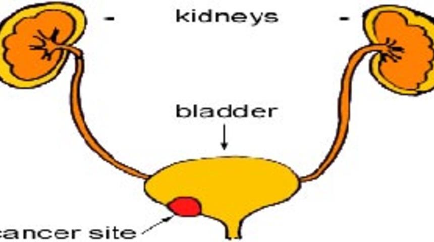 Mesane kanseri neden çok sık görülüyor?