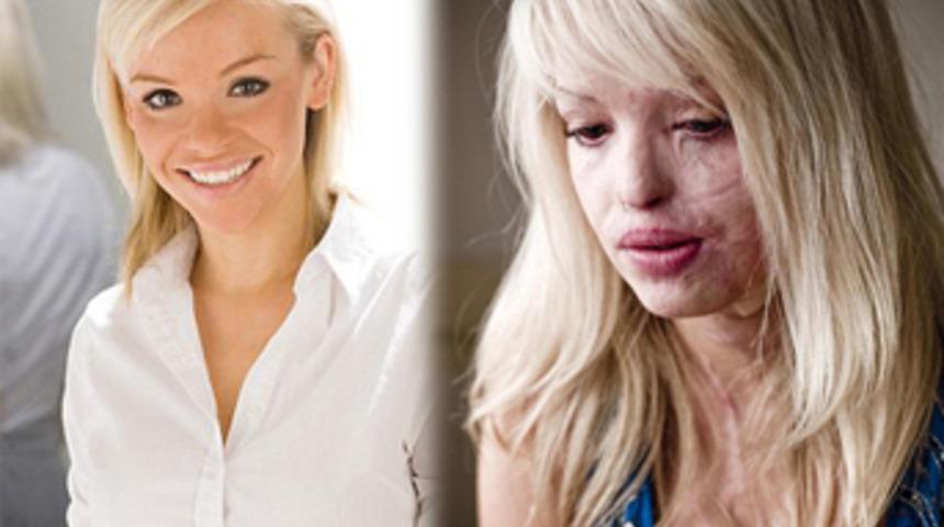 &Uuml;nl&uuml; sunucu asit kurbanı