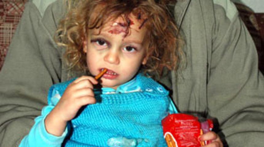 Vahşetin izlerini y&uuml;z&uuml;nde taşıyor