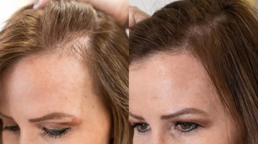 Saçlarınız sürekli dökülüyorsa dikkat! Saç dökülmesine son veren en etkili ve doğal yöntem