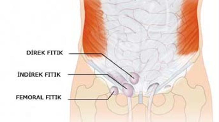 Kasık fıtığında a&ccedil;ık mı kapalı ameliyat mı?