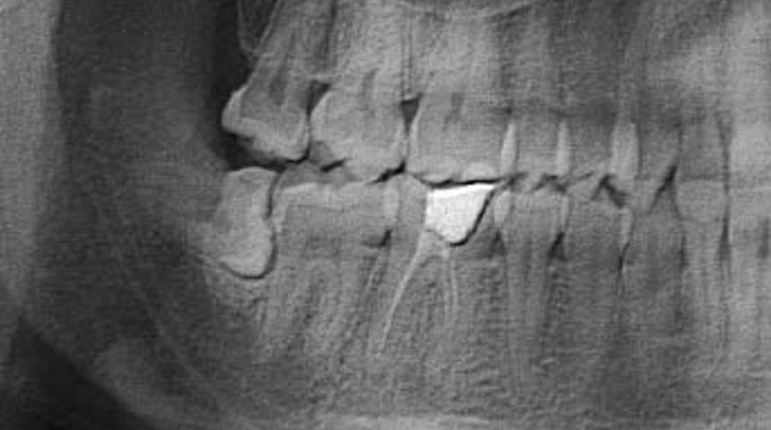 Yirmi yaş dişleri hangi durumlarda çekilmeli?