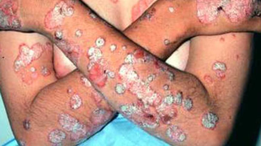 Dikkat edilmesi gereken hastalık: Sedef