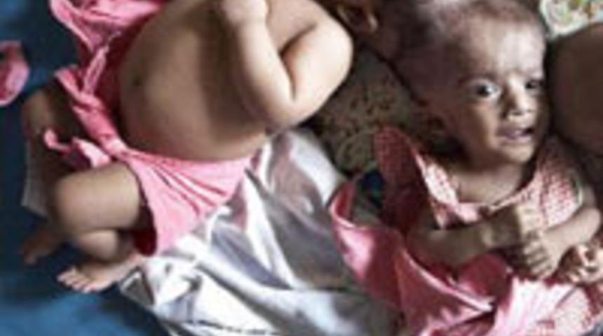 Siyam ikizleri artık &ouml;zg&uuml;r