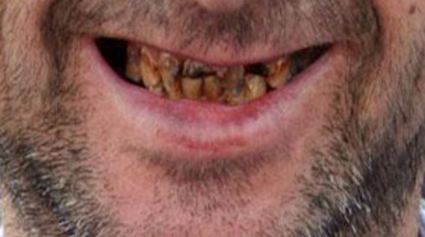 &Ccedil;&uuml;r&uuml;yen dişleri 17 yıllık evliliğini bitirdi