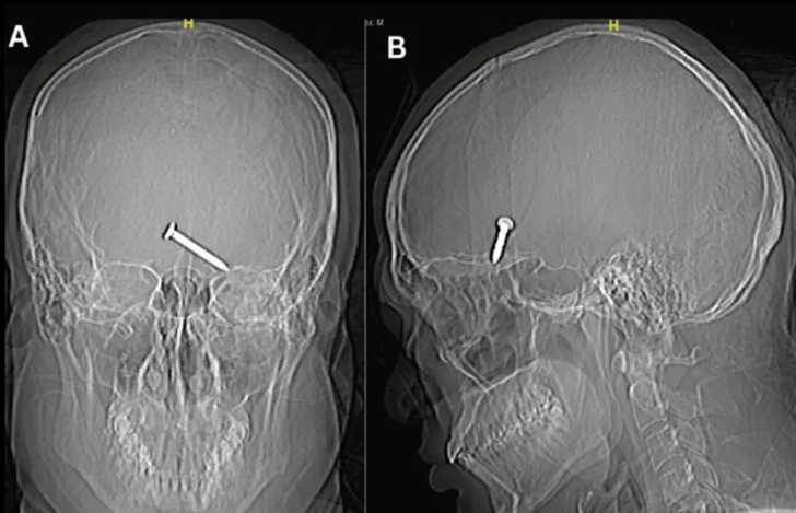 Korkunç iş kazası! İnşaat işçisinin gözünden giren çivi beynine saplandı... Mucizevi bir şekilde hayatta kalmayı başardı G2