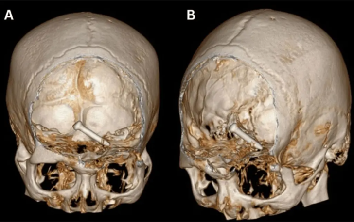 Korkunç iş kazası! İnşaat işçisinin gözünden giren çivi beynine saplandı... Mucizevi bir şekilde hayatta kalmayı başardı G3