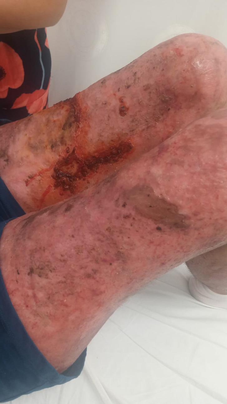 'Aynaya bakamıyorum, eski ben değilim artık' İş kazasında vücudunun yüzde 80'i yandı! 'Güneşe bile çıkamıyorum' G3