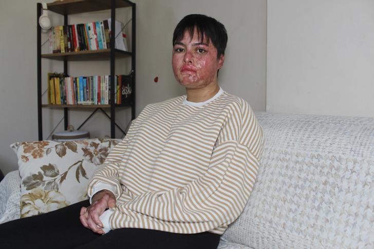 'Aynaya bakamıyorum, eski ben değilim artık' İş kazasında vücudunun yüzde 80'i yandı! 'Güneşe bile çıkamıyorum' G1