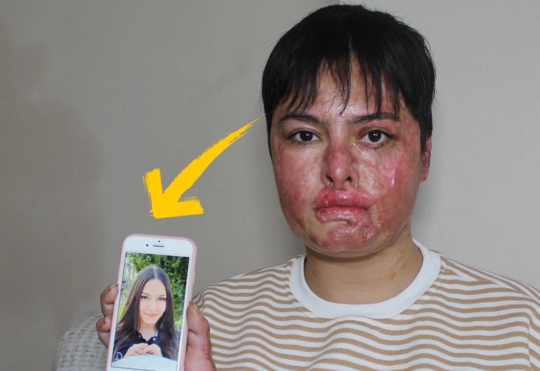 'Aynaya bakamıyorum, eski ben değilim artık' İş kazasında v&uuml;cudunun y&uuml;zde 80'i yandı! 'G&uuml;neşe bile &ccedil;ıkamıyorum'